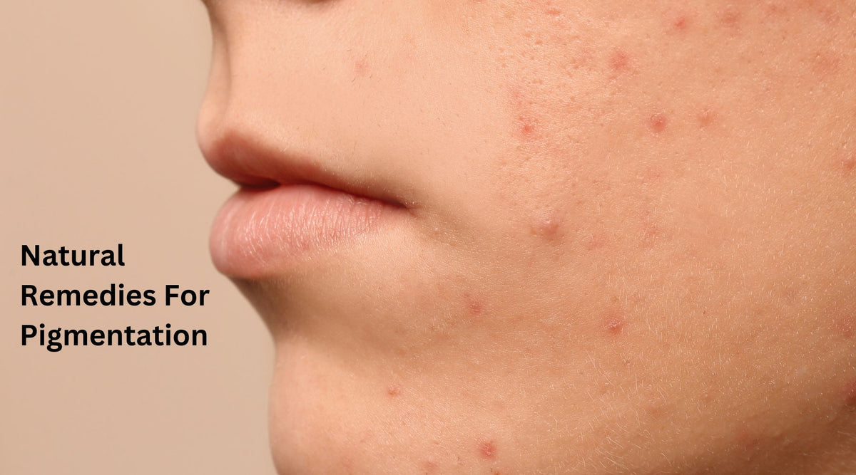 Natural Remedies For Pigmentation HERBCIENCE